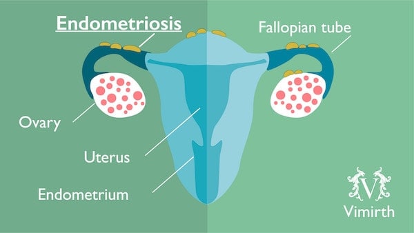 endometriosis