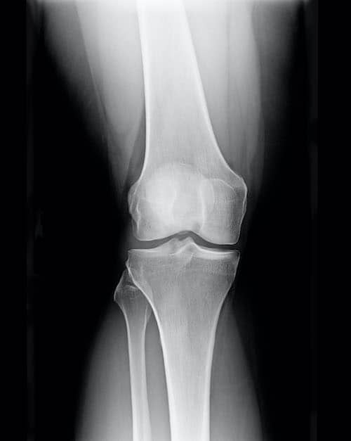 knee arthritis 